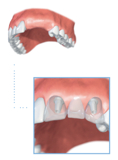 multiple teeth denture